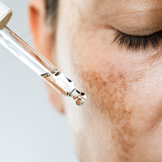 Melasma Treatment Brisbane